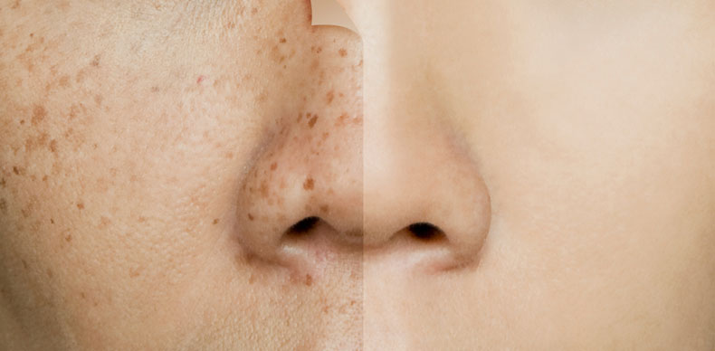 لک های پوستی مشکلات رایج پوستی هستند که می توانند در اثر آرایش، عرق، روغن یا مواد دیگر ایجاد شوند. آنها می توانند توسط آکنه، روزاسه یا اگزما ایجاد شوند. درباره علل ایجاد لک های پوستی بیشتر بدانید و